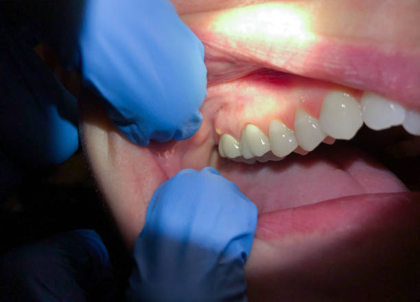 Best Emergency Dental Services for Seniors in Olcott, NY