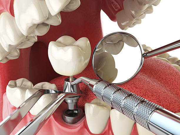 Best Emergency Dentist for Knocked-Out Tooth in Olcott, NY